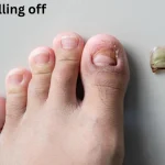 toe nail falling off